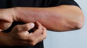 Psikodermatolojik Hastalıklar